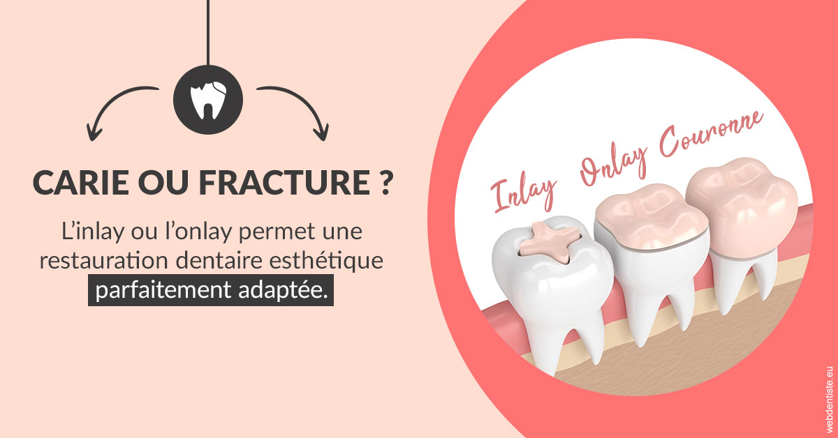 https://dr-riedel-yann.chirurgiens-dentistes.fr/T2 2023 - Carie ou fracture 2