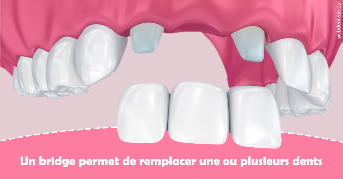 https://dr-riedel-yann.chirurgiens-dentistes.fr/Bridge remplacer dents 2