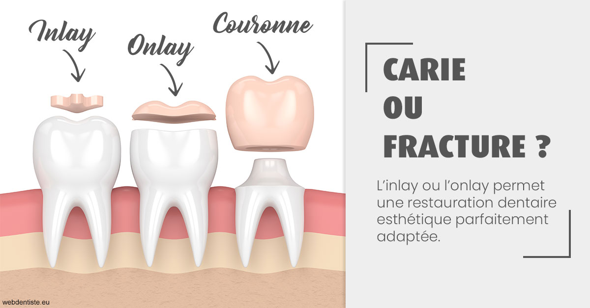https://dr-riedel-yann.chirurgiens-dentistes.fr/T2 2023 - Carie ou fracture 1