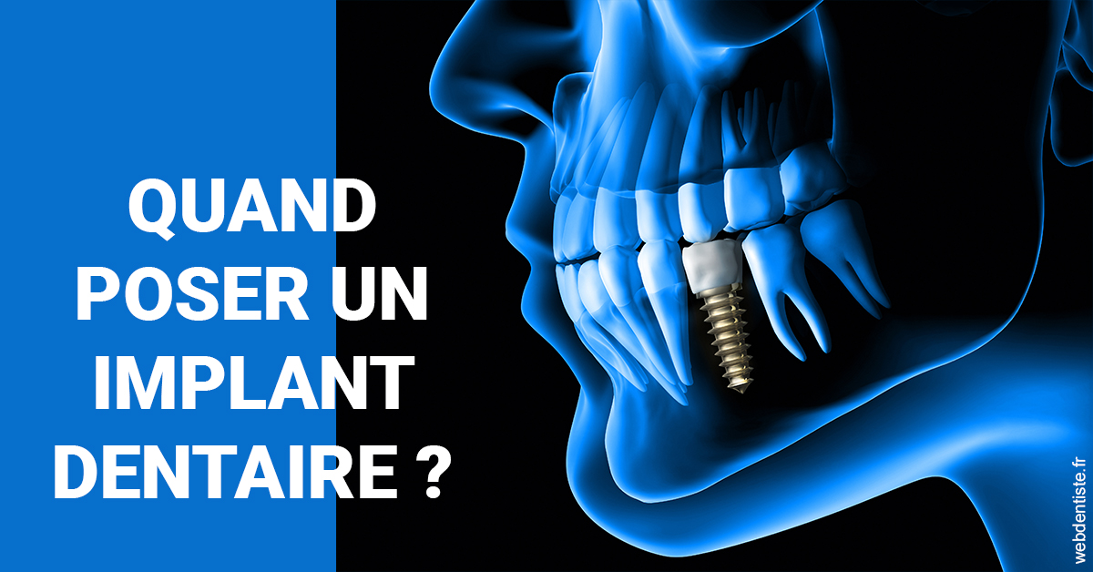 https://dr-riedel-yann.chirurgiens-dentistes.fr/Les implants 1